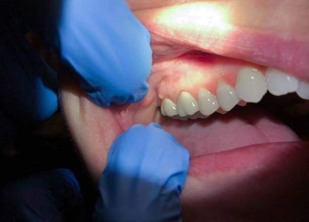 Best Lost Filling or Crown Replacement in Skidmore, TX